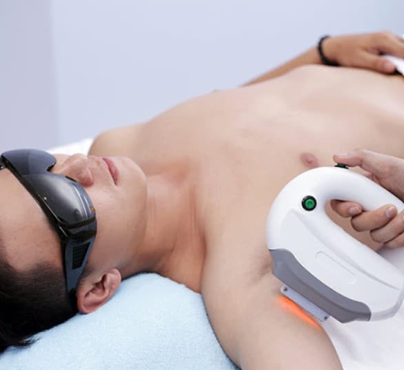Triệt lông vùng râu mép cho nam